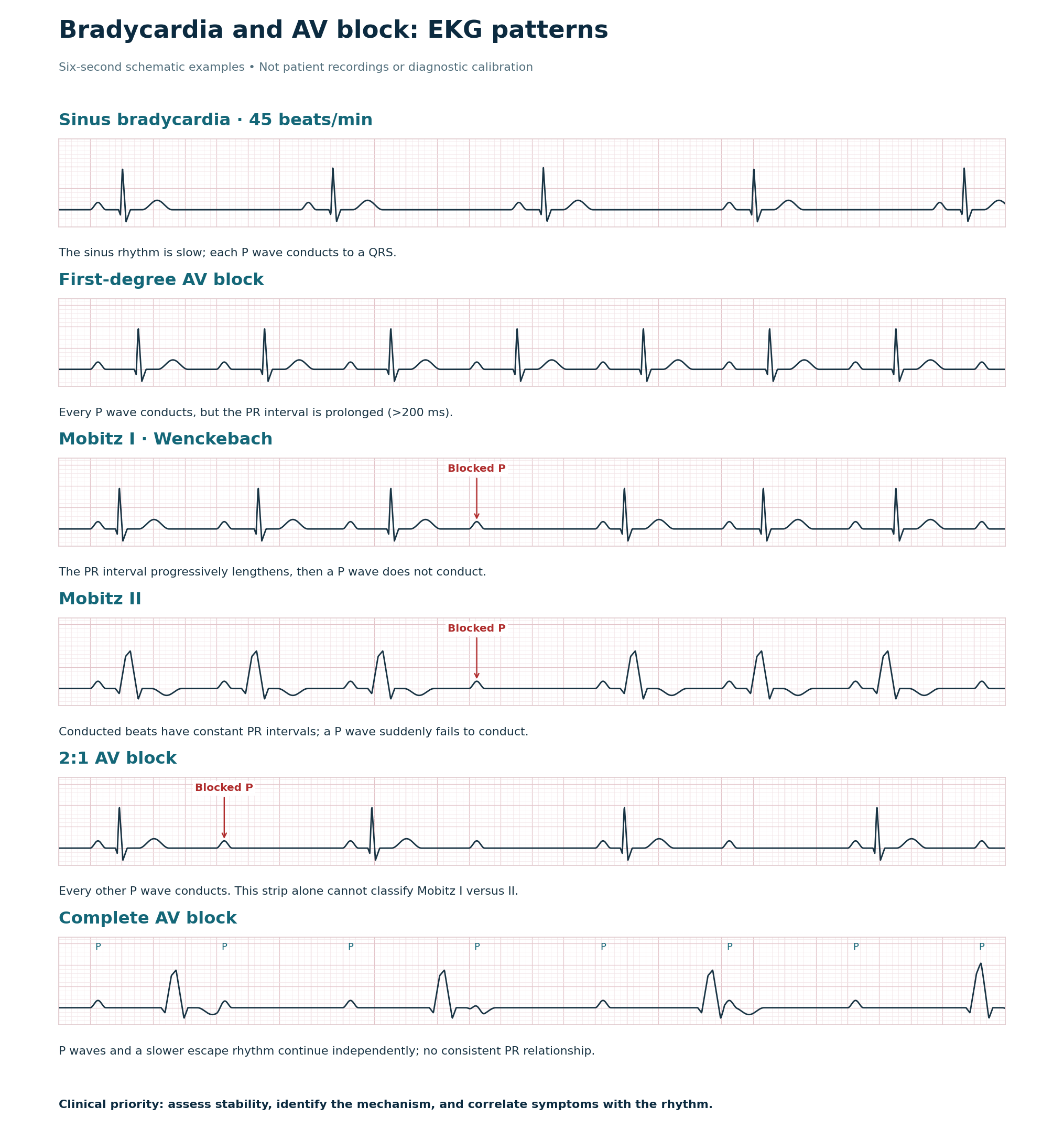 Six illustrative strips comparing sinus bradycardia, first-degree block, Mobitz I, Mobitz II, 2:1 block, and complete AV block