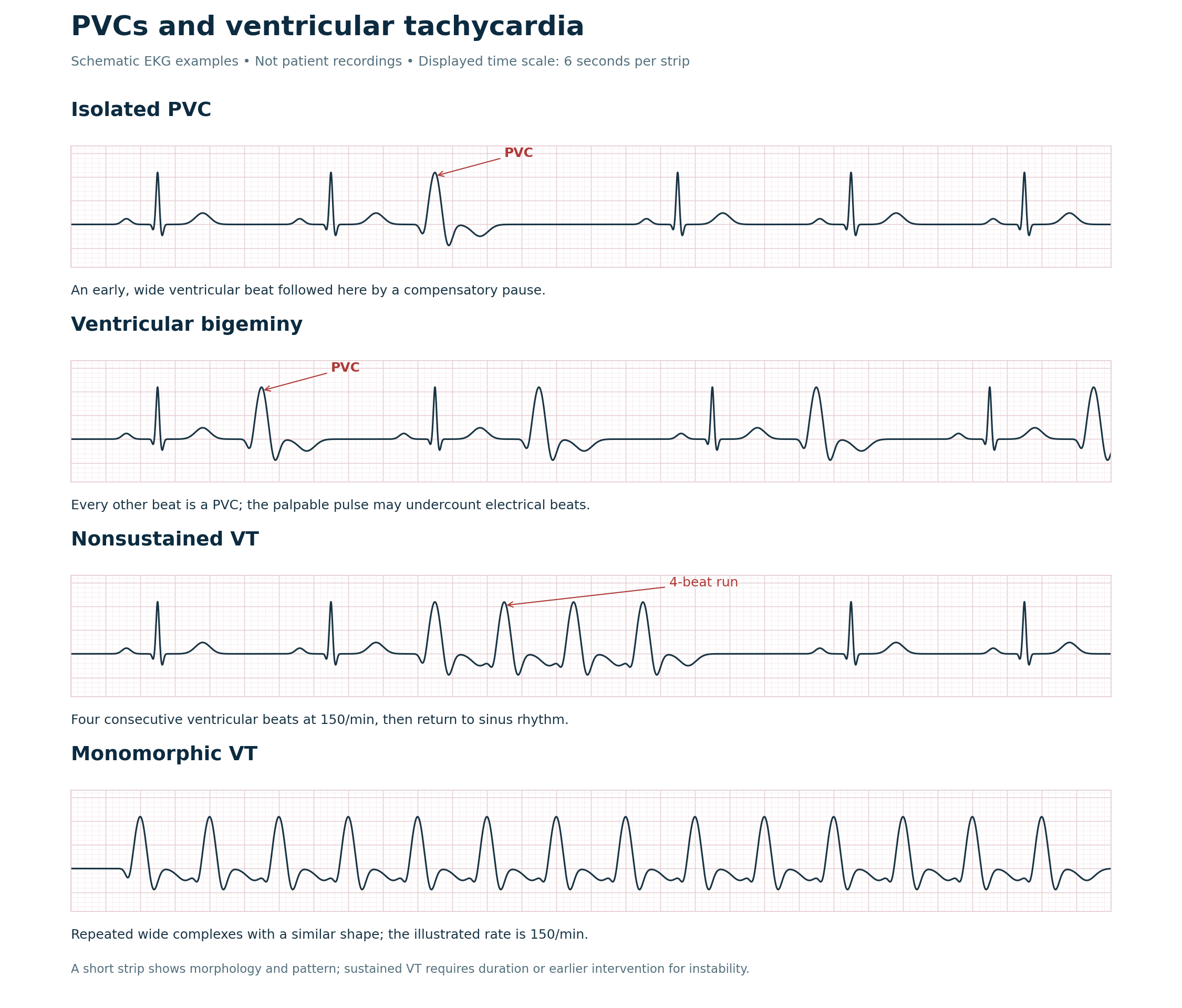 Four schematic EKG strips showing an isolated PVC, ventricular bigeminy, a four-beat run of NSVT, and monomorphic VT