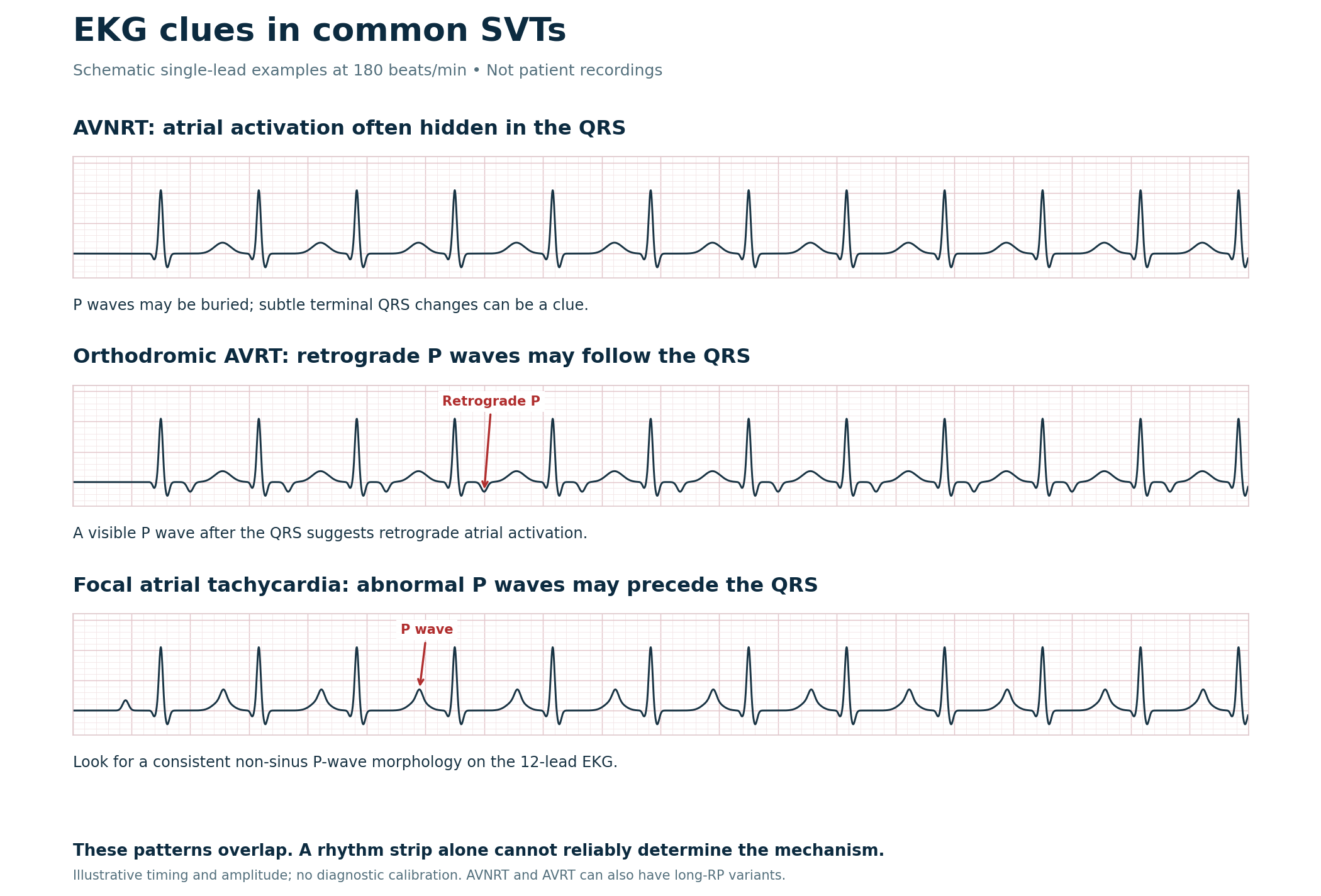 Three schematic regular narrow-complex tachycardia strips showing hidden, retrograde, and preceding P waves