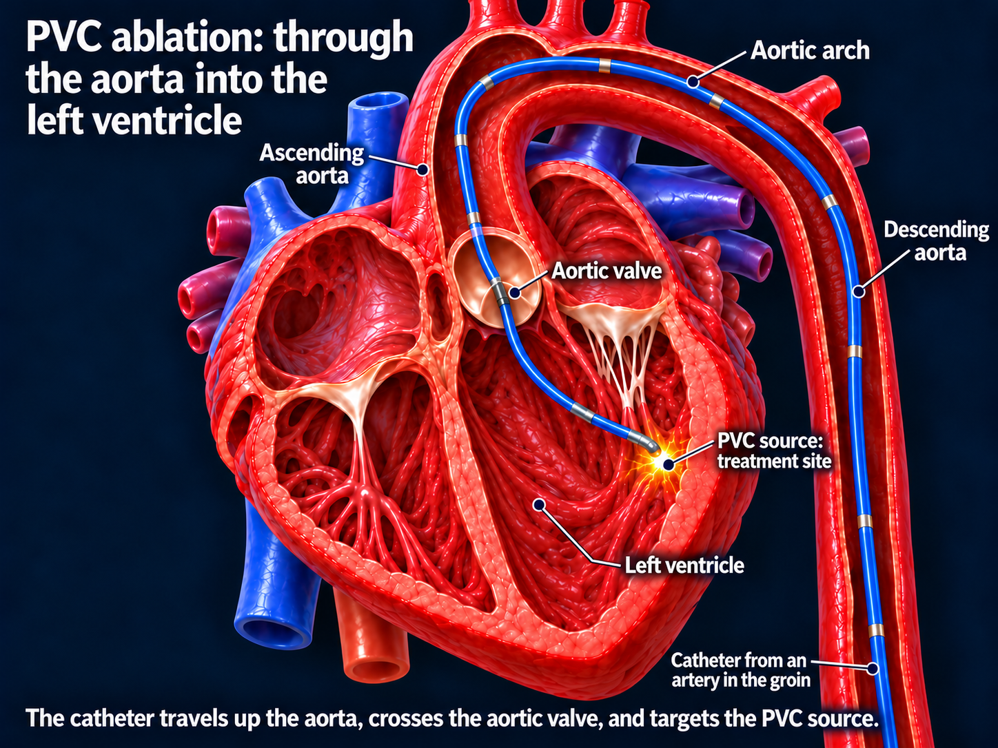A catheter travels up the aorta, across the aortic valve, and into the left ventricle to treat a PVC source.