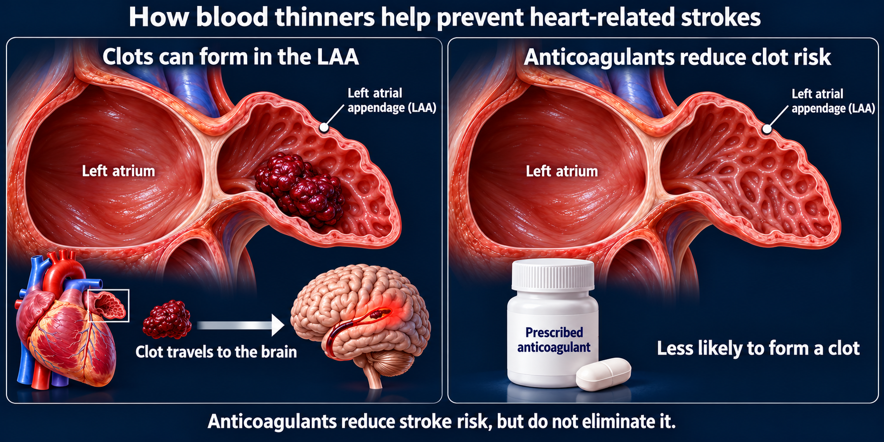 LAA clot risk compared with reduced clot formation on prescribed anticoagulation