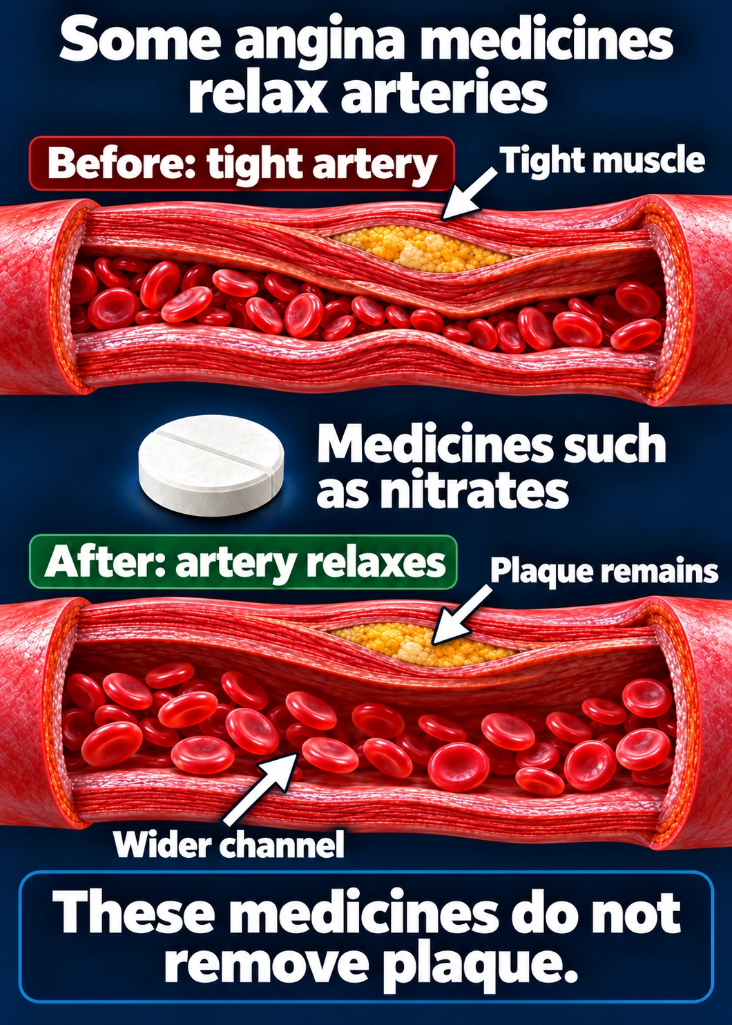 A tight artery compared with the same artery relaxed by some anti-anginal medicines, leaving more room for blood flow.